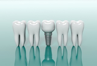 Diagram of teeth lined up next to a dental implant