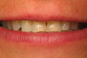 Yellow teeth before porcelain veneers