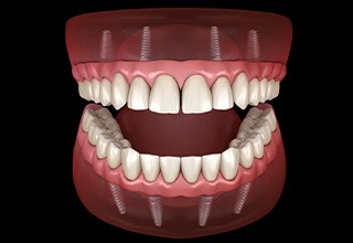 A 3D illustration of all-on-4 dentures