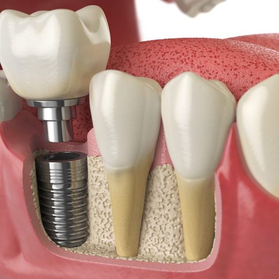 a 3 D illustration of a dental implant in the jawbone