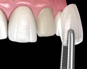 Veneer being placed on tooth with enamel removed